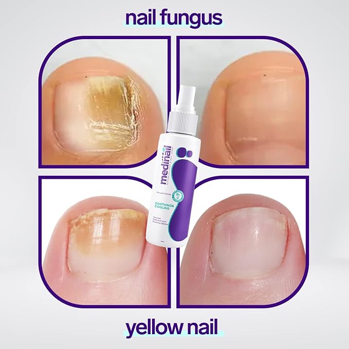 Nail Fungus Spray